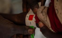 Close-up of a Mid-Upper Arm Circumference (MUAC) tape placed around a child’s arm showing severe acute malnutrition during screening at an MSF mobile clinic in Thanakuach, Jonglei State, South Sudan. 