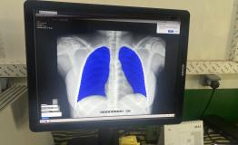 Use of AI to Support TB Diagnosis in Batangafo, CAR