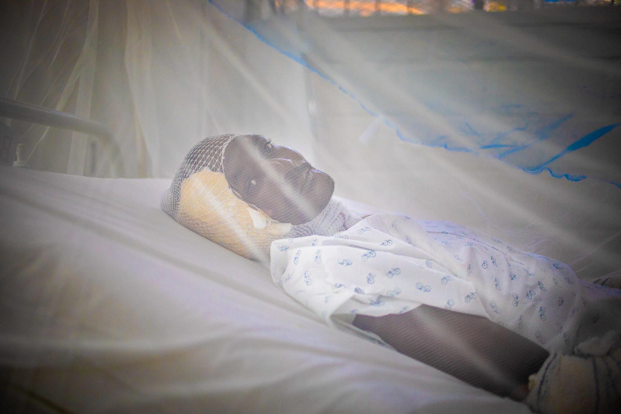 Kenol Coman has extensive burns on several parts of his body.
