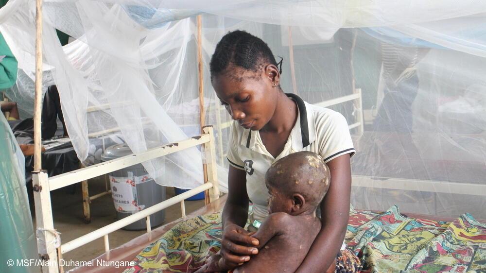 Mompondele Yangala, a 1-year-old child suffering from Mpox, in his mother's arms, hospitalised at the Bolomba general referral hospital, supported by MSF. His mother had also been treated for the disease.