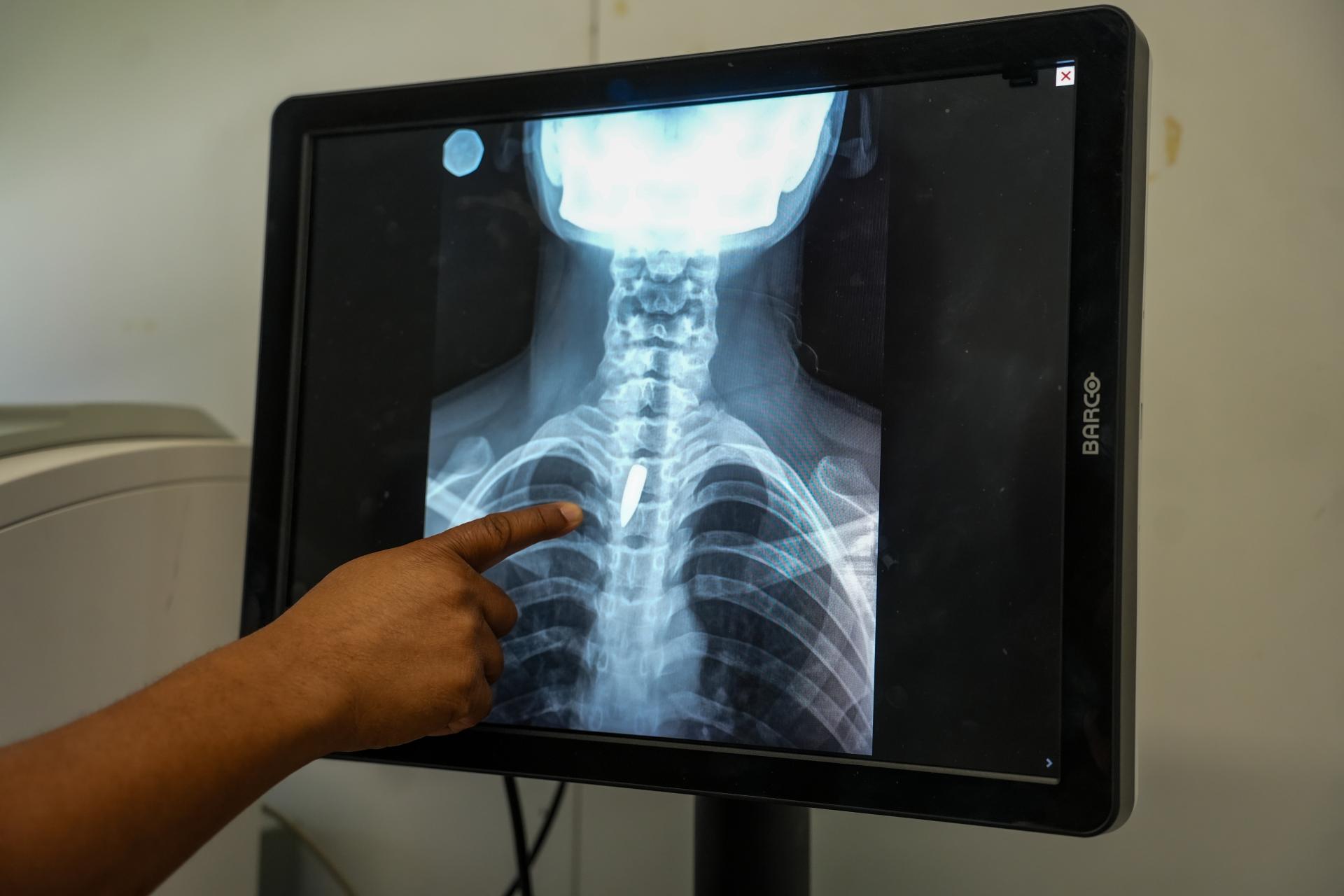 An X-ray shows a bullet lodged in the chest of Linda, 21. Surgeons determined it was too risky to remove, so she will have to continue living with it.
