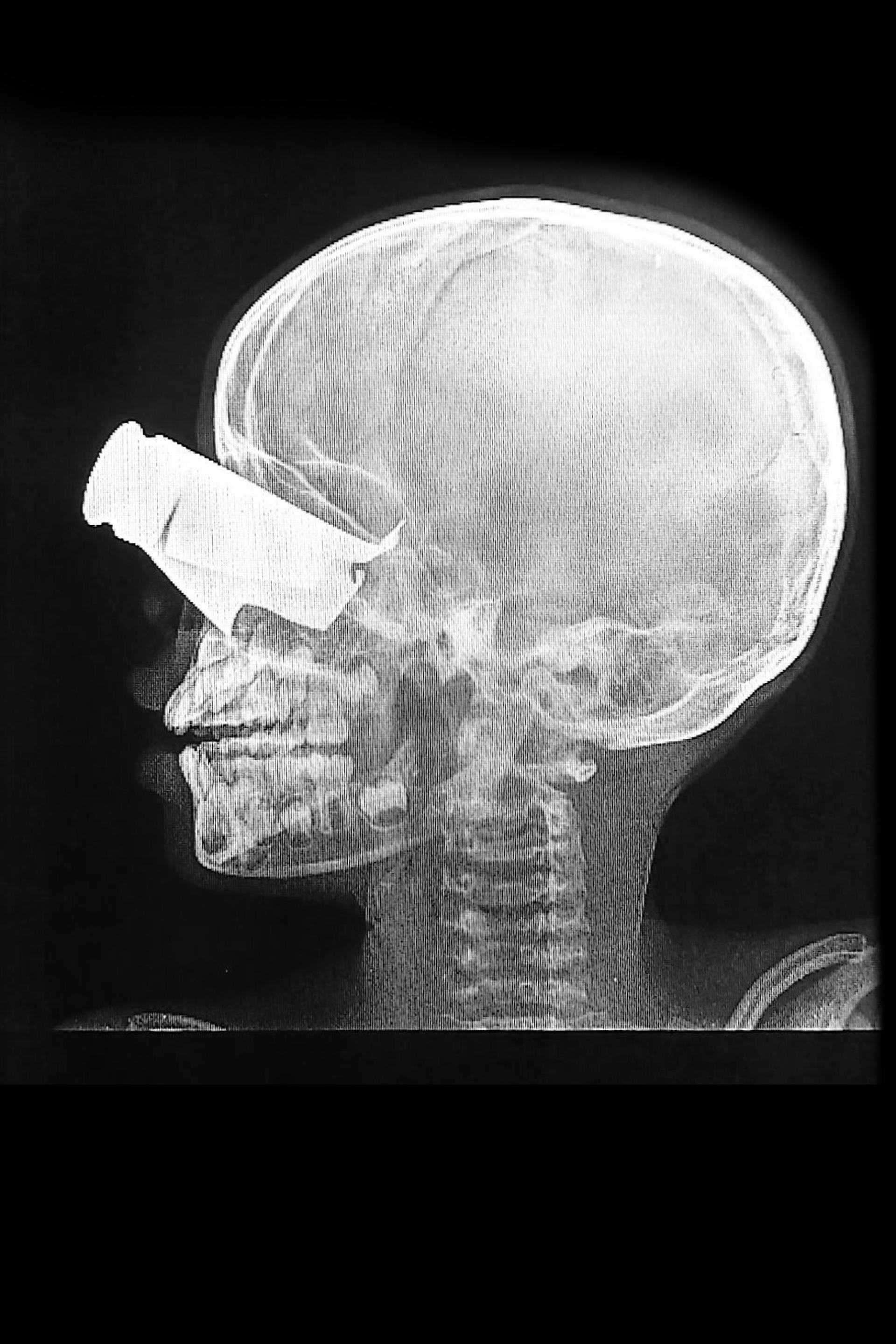 Boy with shrapnel wound