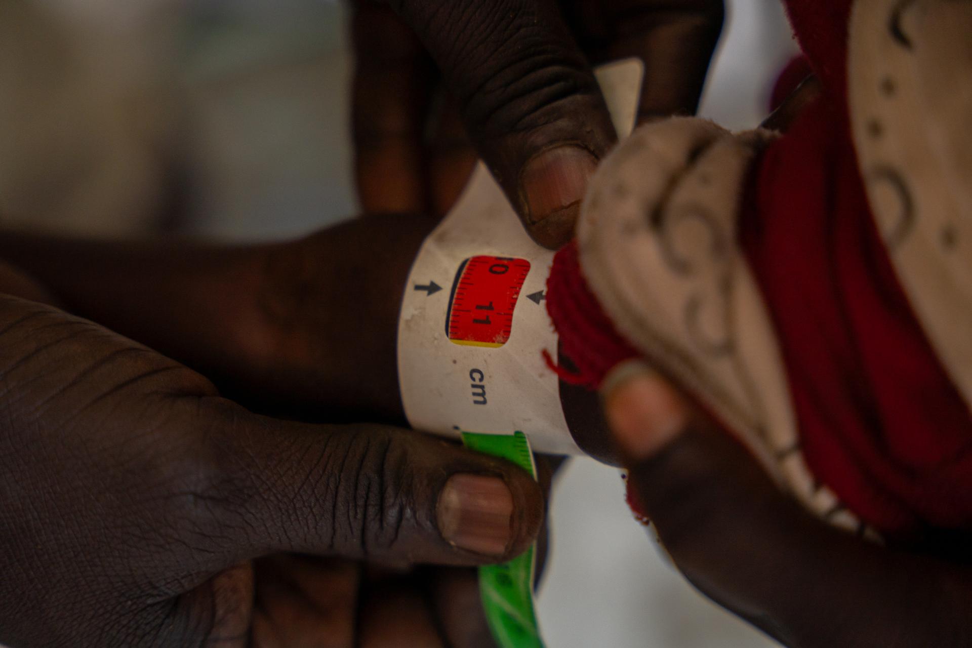 Close-up of a Mid-Upper Arm Circumference (MUAC) tape placed around a child’s arm showing severe acute malnutrition during screening at an MSF mobile clinic in Thanakuach, Jonglei State, South Sudan. 