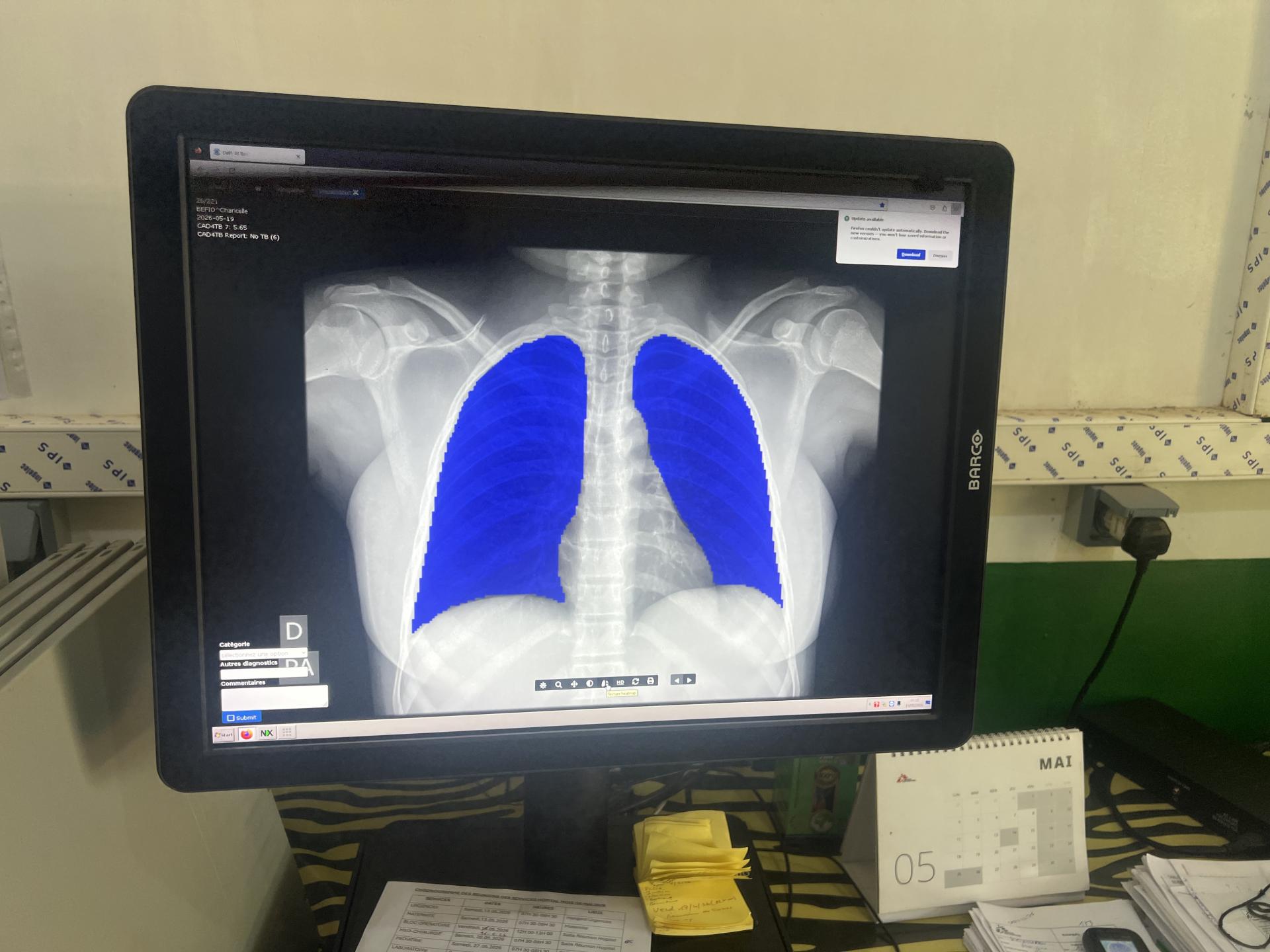 Use of AI to Support TB Diagnosis in Batangafo, CAR