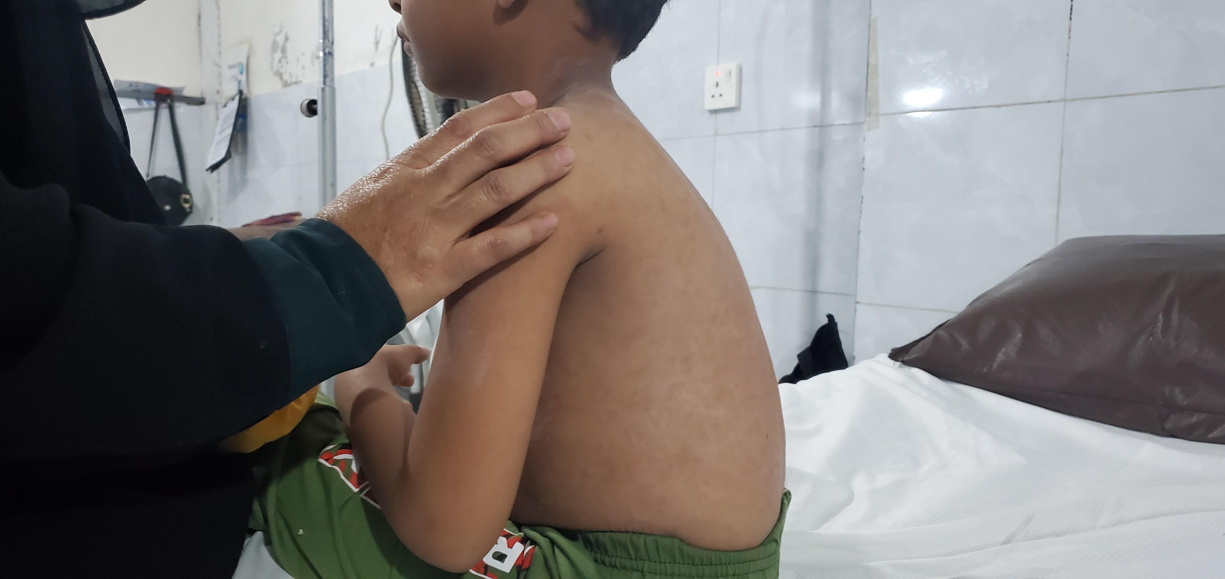 A child suffering from measles is receiving treatment in the measles isolation unit inside MSF’s mother and child hospital in Taiz Houban.