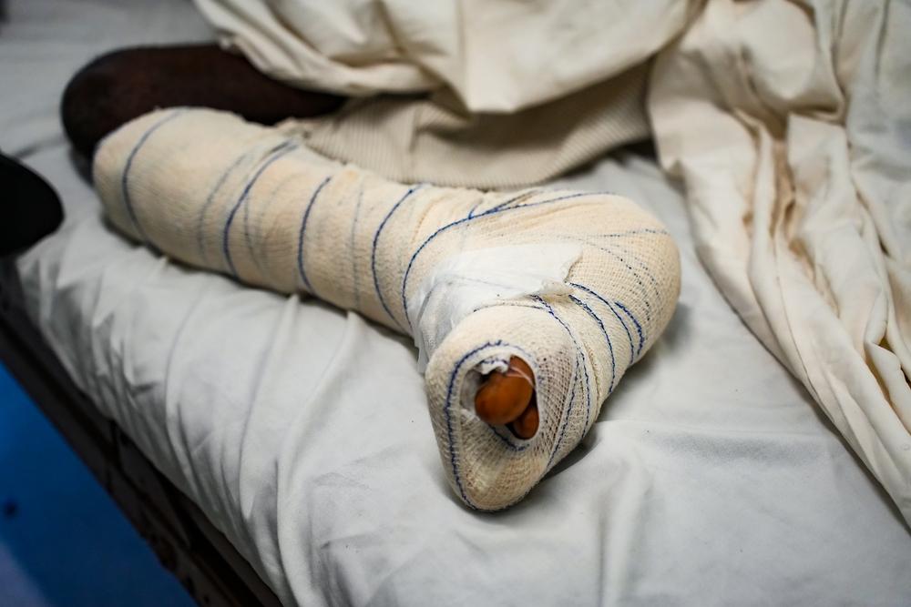 The bandaged leg of Anderson, 35, a kitchenware vendor who was severely injured in the heel by a bullet fired from a police armored vehicle.