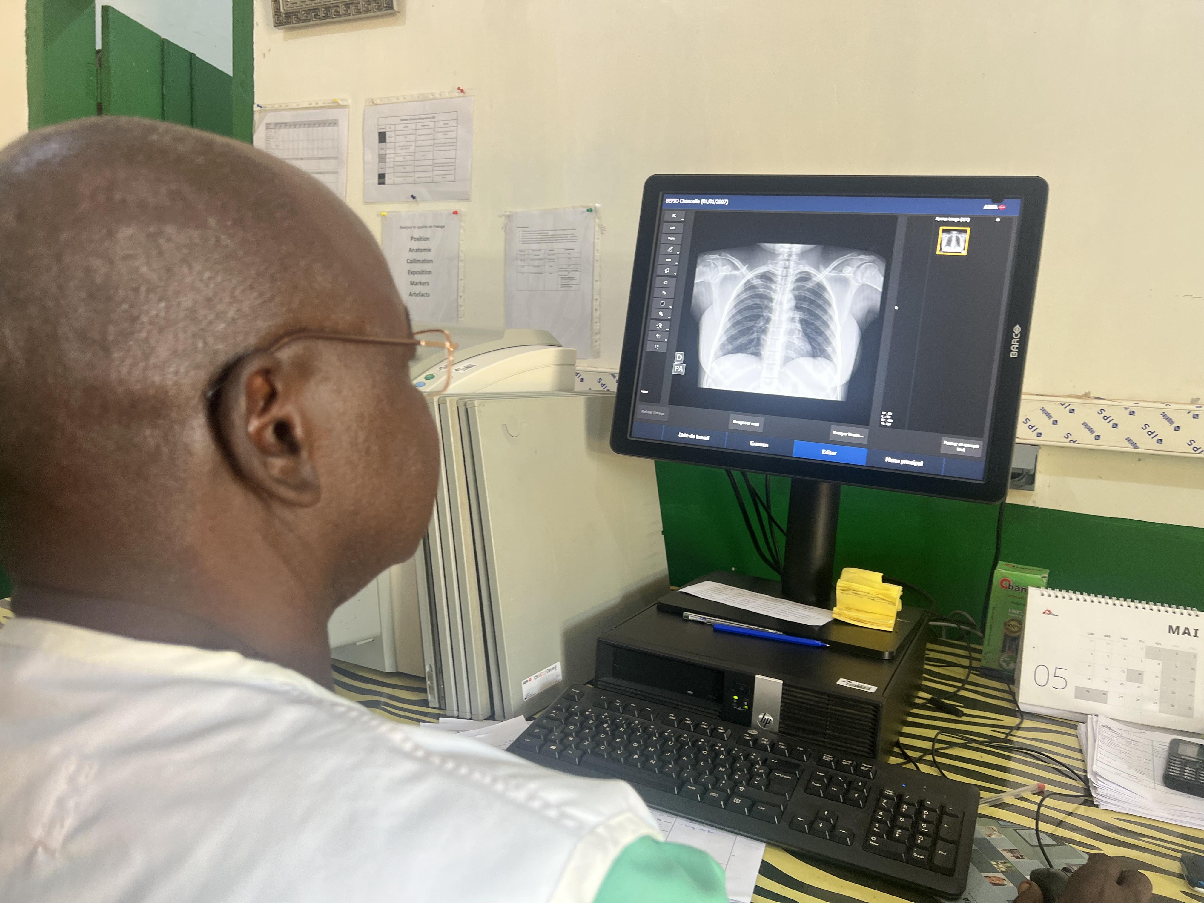 Use of AI to Support TB Diagnosis in Batangafo, CAR